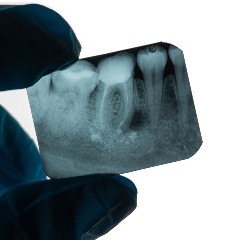 Dentistry, Atlanta, GA | X-Rays | Collier Hills Dentistry